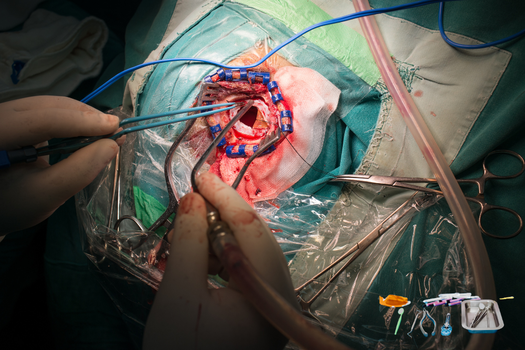 Schema ernia inguinale e trattamento chirurgico